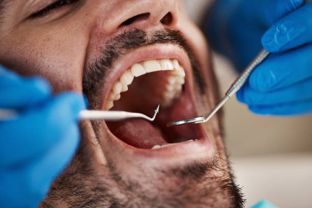 Best Knocked-Out Tooth (Avulsed Tooth) Treatment in Leavenworth, WA
