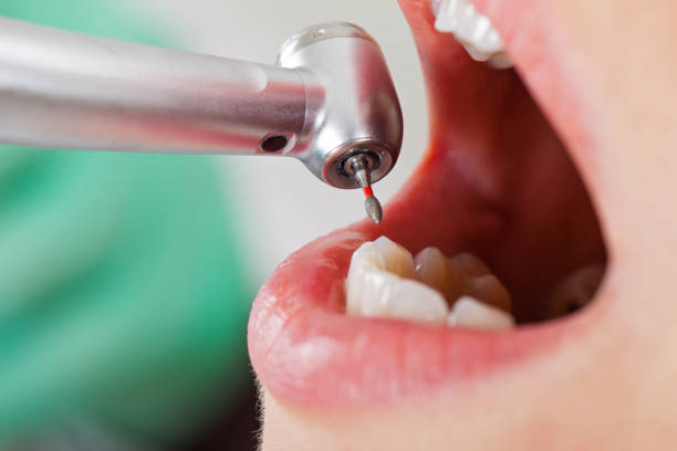 Best Emergency Root Canal Therapy in Leavenworth, WA